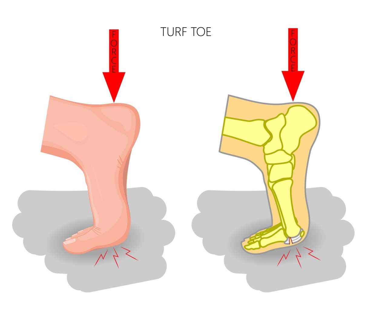 Turf Toe