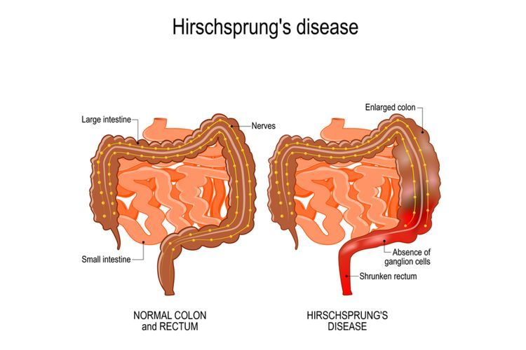 Penyakit Hirschprung