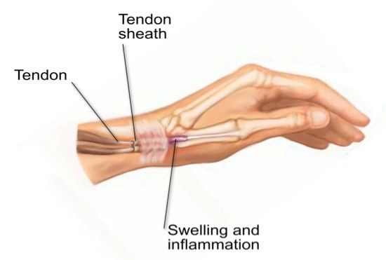 Tendinitis dan Tenosinovitis