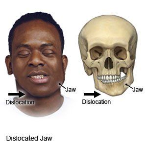 Dislokasi Rahang Bawah (Mandibula)