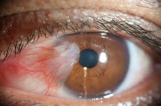 Pterygium