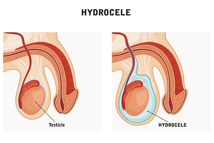 Hidrokel 