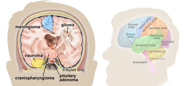 Tumor Otak