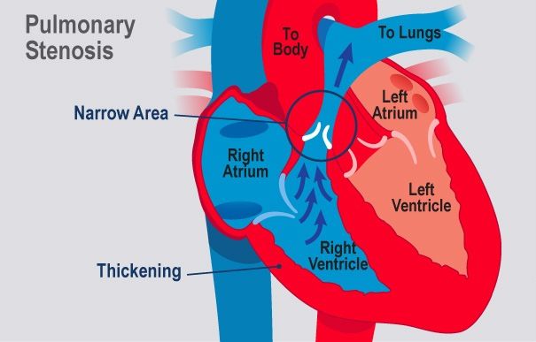 Stenosis Katup Pulmonal