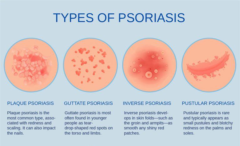 Psoriasis