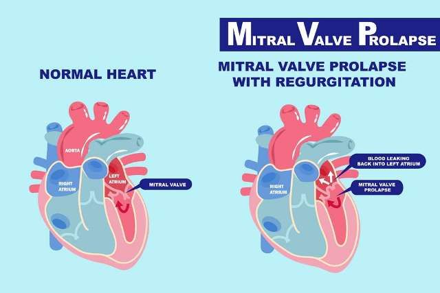 Prolaps Katup Mitral