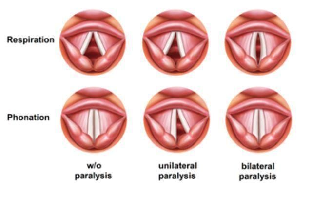 Kelumpuhan Pita Suara