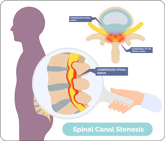 Stenosis Spinal