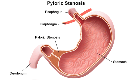 Hypertrophic Pyloric Stenosis (Stenosis Pilorus Hipertrofik)