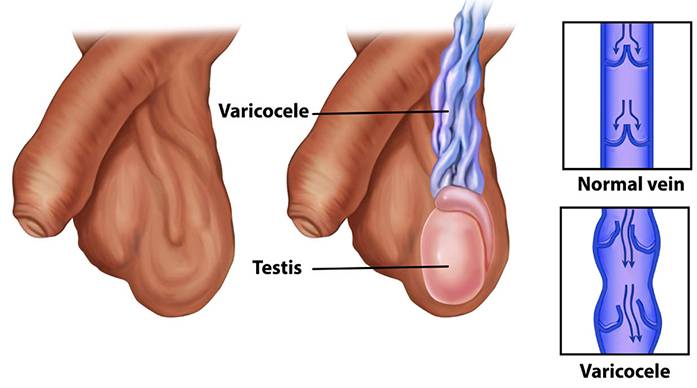 Varikokel