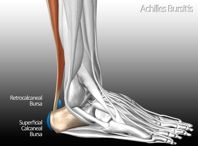 Bursitis Tendon Achilles Anterior