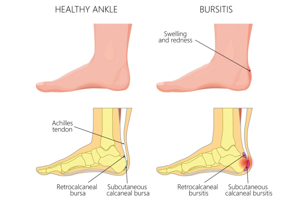 Calcaneal Bursitis