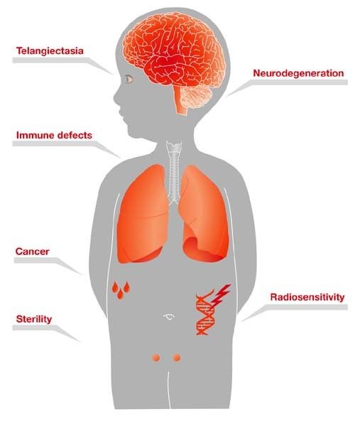 Ataxia-Telangiectasia