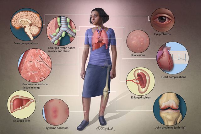 Sarkoidosis