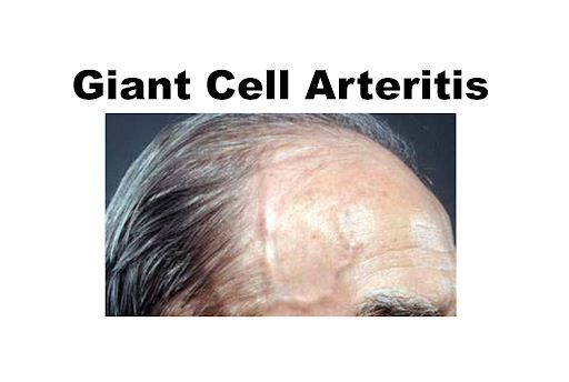 Giant Cell Arteritis