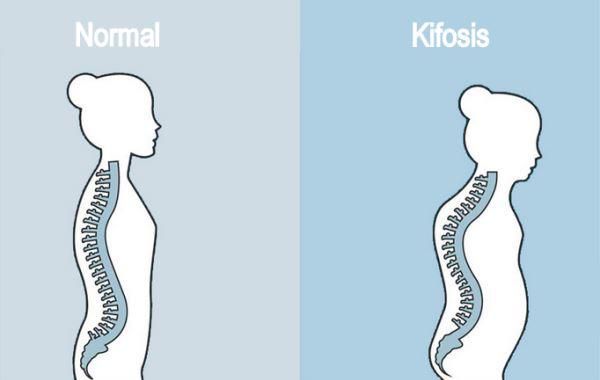 Kifosis (Penyakit Scheuermann)