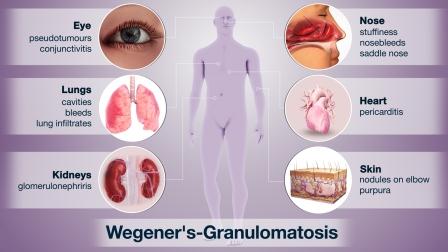 Granulomatosis Wegener