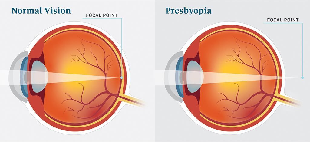 Presbiopia; Kemunduran Penglihatan Pada Orang Tua