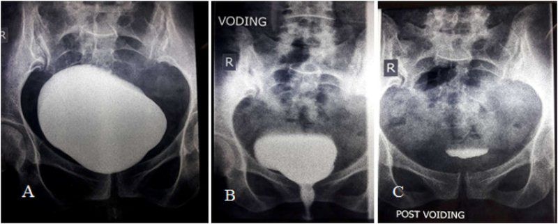 Pemeriksaan Kandung Kemih (Sistografi Retrograd)