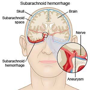 Perdarahan Subarachnoid