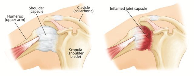 Sindroma Frozen Shoulder