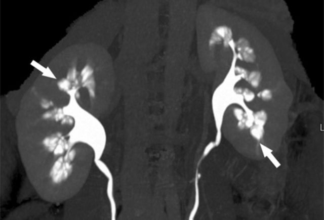 Medullary Sponge Kidney