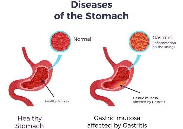 Gastritis (Maag)