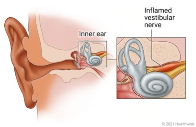 Neuronitis Vestibularis