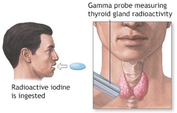 Tes Yodium pada Kelenjar Tiroid