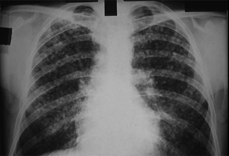 Pneumokoniosis (Penyakit Paru-paru Hitam)