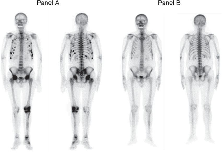 Skintigrafi Tulang