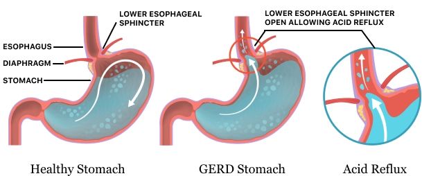 Refluks Asam Lambung (Refluks Gastroesofageal)