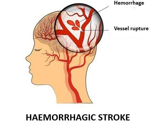 Stroke Hemoragik