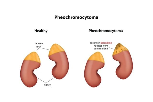 Feokromositoma