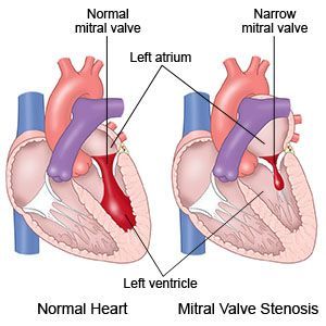 Stenosis Katup Mitral