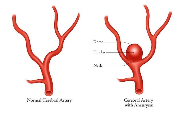 Aneurisma